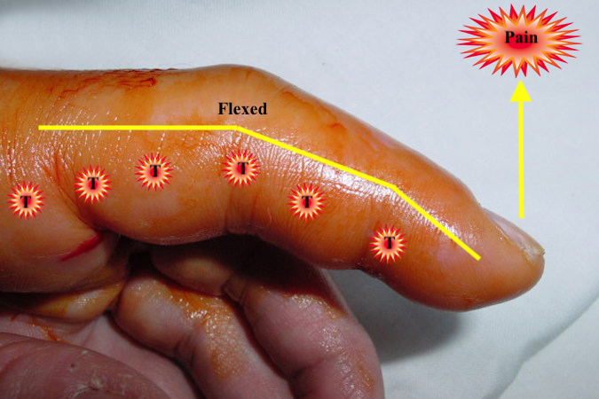 kanavel-s-sign-hand-surgery-resource